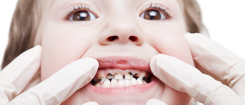 Preventing Childhood Tooth Decay